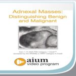 Adnexal-Masses-Distinguishing-Benign-and-Malignant