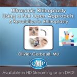 Ultrasonic Rhinoplasty Using a Full Open Approach A Revolution in Rhinoplasty at 50€