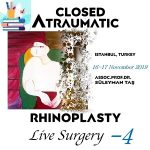 Closed Atraumatic Rhinoplasty Live Surgery 4