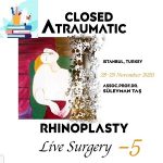 Closed Atraumatic Rhinoplasty Live-Surgery Video 5